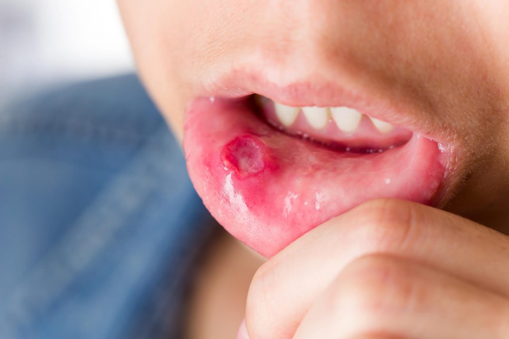 Câncer bucal o que é, como prevenir e tratar