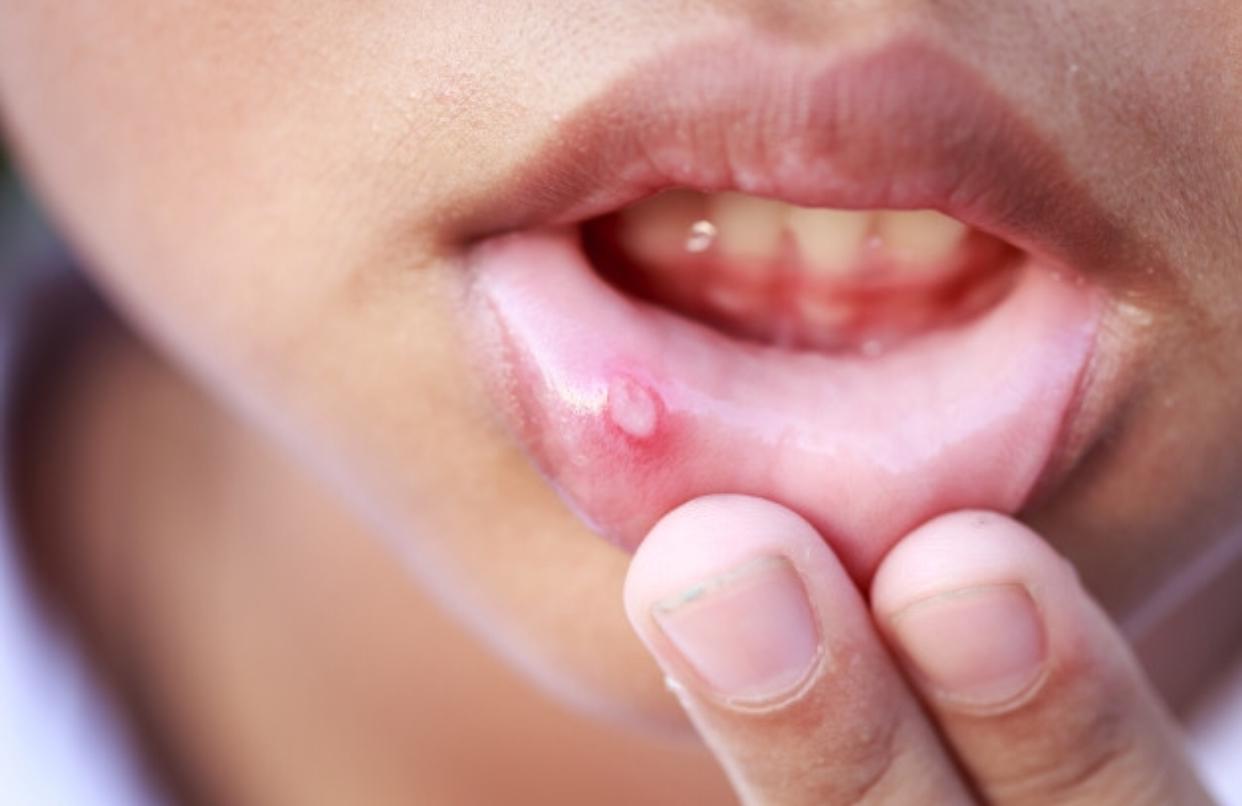 Cancer bucal sintomas. Papilloma virus alla bocca immagini